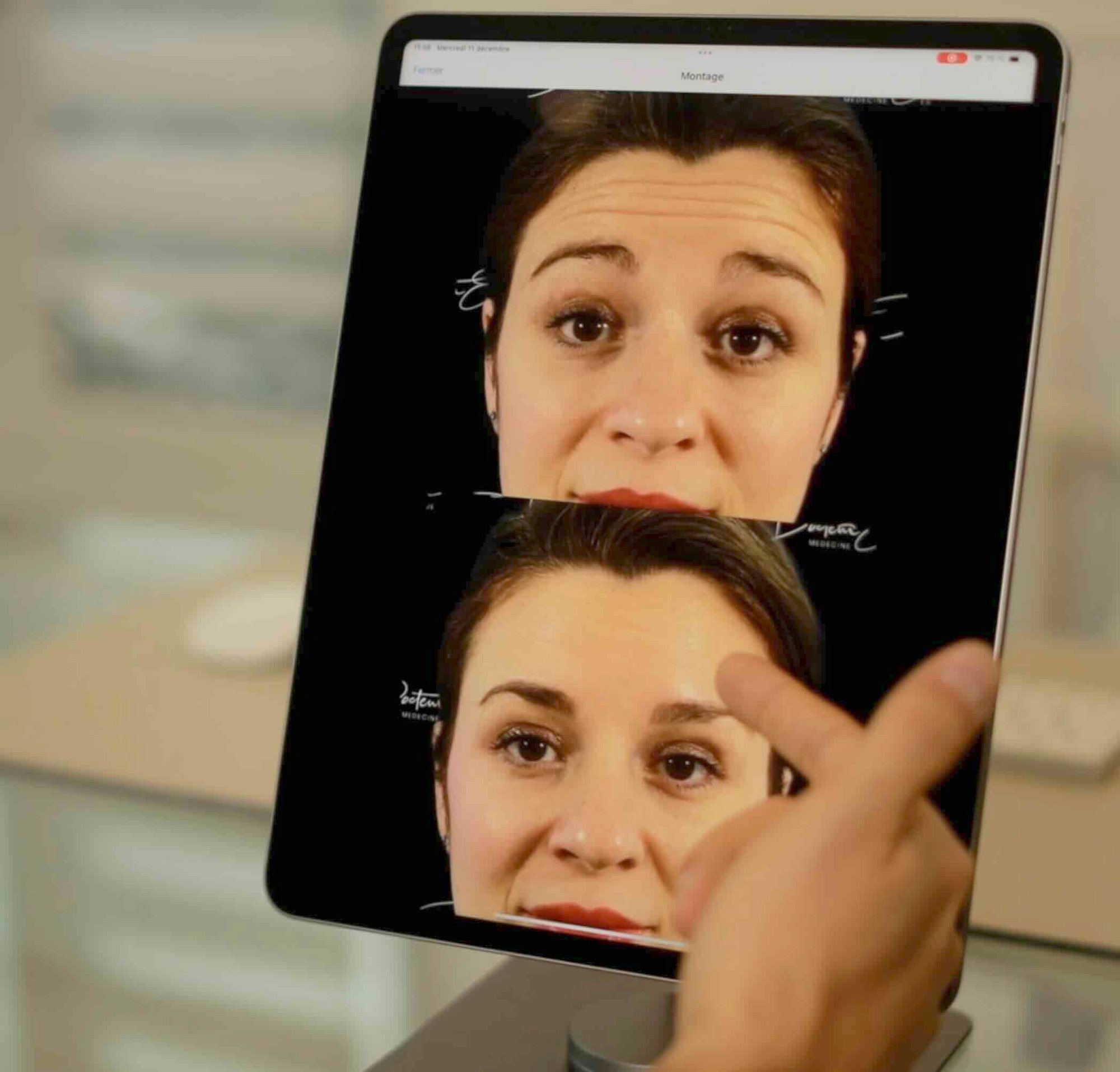 Comparaison avant/après affichée sur l'application NM Capture, mettant en évidence les résultats esthétiques avec des images alignées et précises.